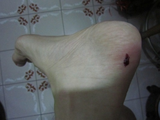 Injured…